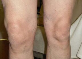 Pirms Osteflex lietošanas Nilsa ceļi dienas beigās bija pietūkuši.
