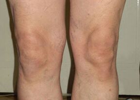 Pēc Osteflex lietošanas kursa locītavas atgriežas normālā stāvoklī